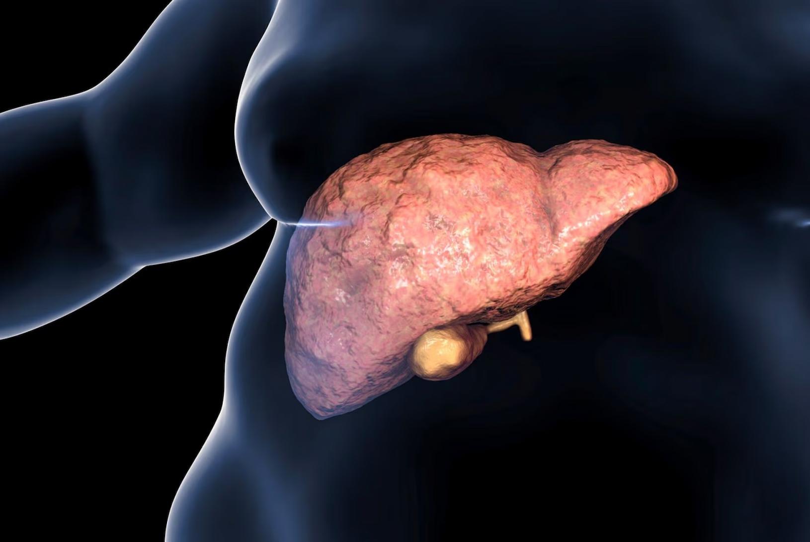 Aumento extraordinario de la cantidad de personas con hígado graso